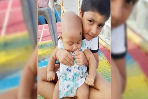 কেটে ফেলা হলো দগ্ধ দুই ভাইবোন ৪ পা