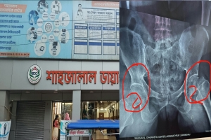 ভুল চিকিৎসায় পঙ্গুত্বের ঝুঁকিতে নারী, সিলেটে অস্ত্রোপচারের প্রস্তুতি